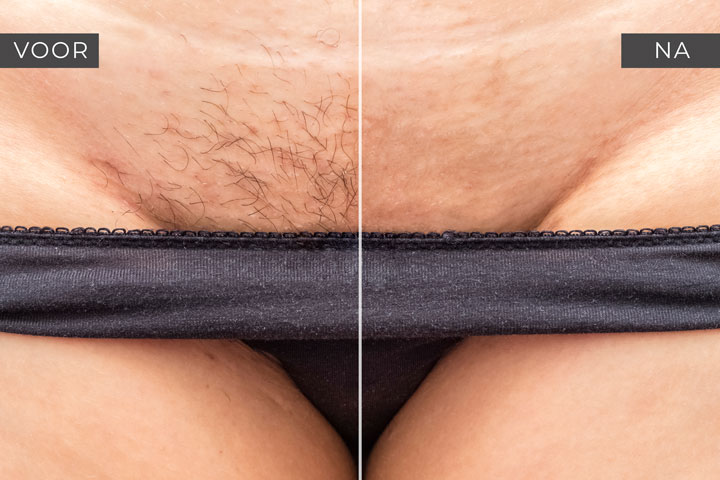 bultjes bikinilijn gaan niet weg